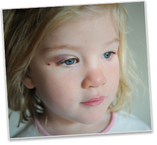 Photo of a young girl with a black eye.